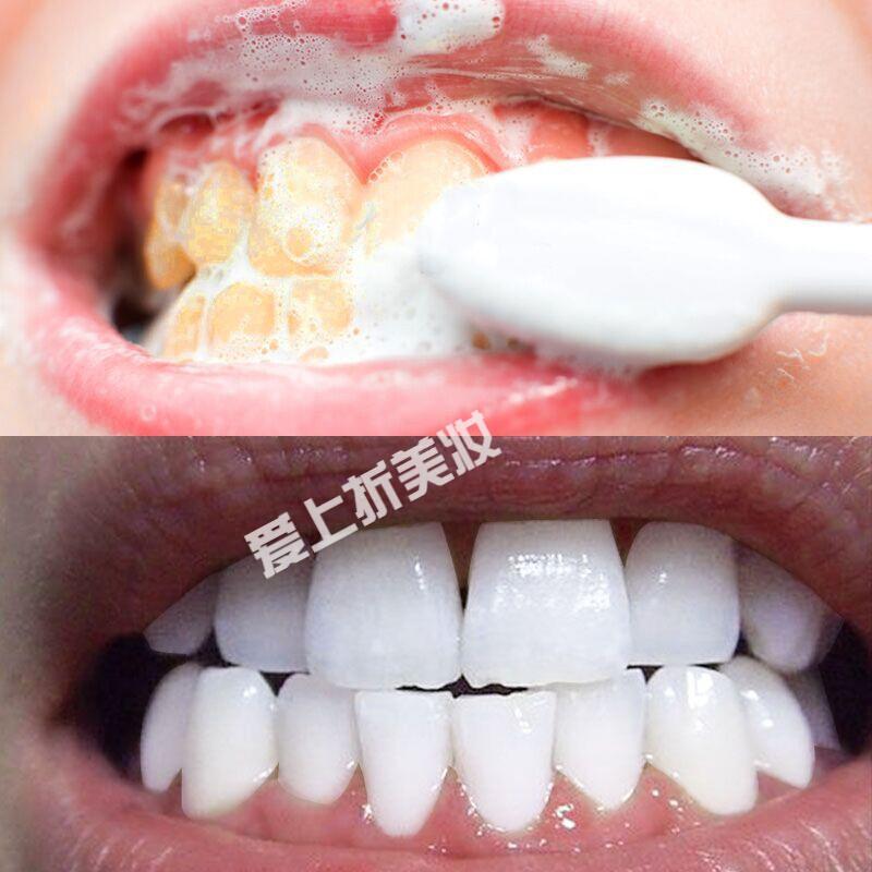 苏宁优选洗牙粉牙变白牙齿神器洗牙白速效去牙渍牙垢烟渍白牙结石高清